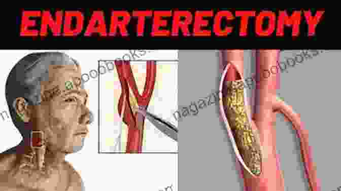 Carotid Endarterectomy Surgery Function And Surgery Of The Carotid And Vertebral Arteries