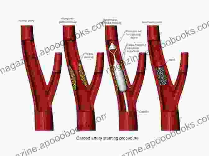 Carotid Stenting Procedure Function And Surgery Of The Carotid And Vertebral Arteries