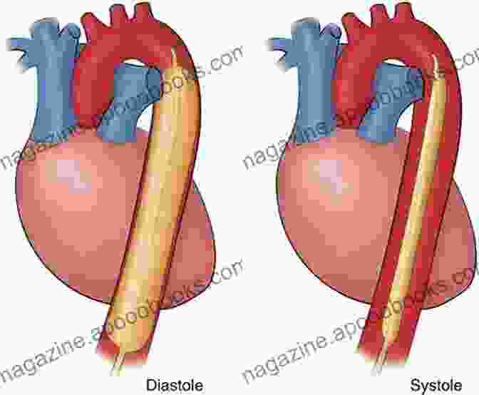 Intra Aortic Balloon Pump Diagram Clinical Application Of Intra Aortic Balloon Pump