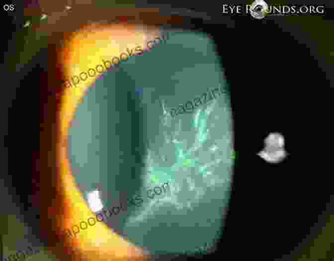 Varicella Zoster Virus Epithelial Keratitis Varicella Zoster Virus Epithelial Keratitis In Herpes Zoster Ophthalmicus: In Vivo Morphology In The Human Cornea