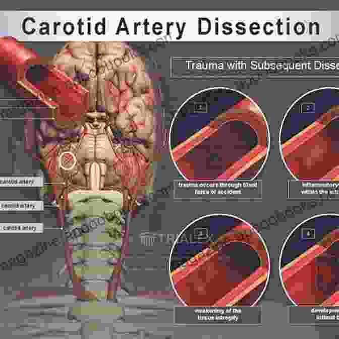 Vertebral Artery Dissection Function And Surgery Of The Carotid And Vertebral Arteries